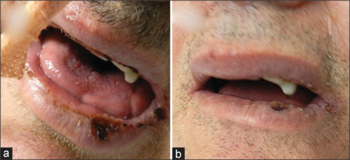 Medical device-related orofacial ulcers: Report of two cases managed with photobiomodulation therapy.