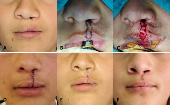 Treatment outcomes of two surgical techniques in secondary reconstruction of unilateral cleft lip and ala nasi utilizing anthropometry assessment: a randomized controlled trial.
