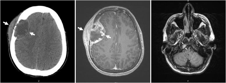 Malignant Paraganglioma With Calvarial Metastases Presenting With Recurrent Catecholamine-Induced Cardiomyopathy