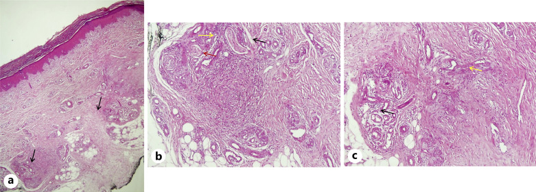 Verrucous Eccrine Angiomatous Hamartoma: A Case Report.