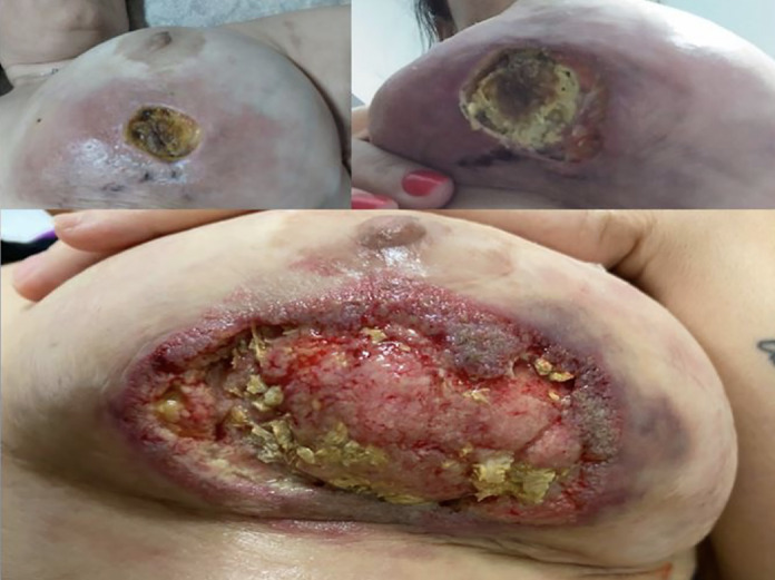 Pyoderma Gangrenosum: A Nightmare for Breast Surgery-Two Case Reports.