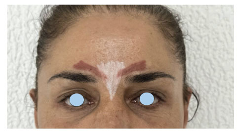 Anatomy, Etiology, Management, and Medico-Legal Implications of Botulinum-induced Blepharoptosis.