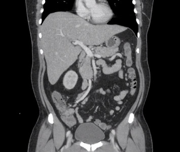 Typhoid Fever as a Cause of Liver Failure in the United States: A Case Report.