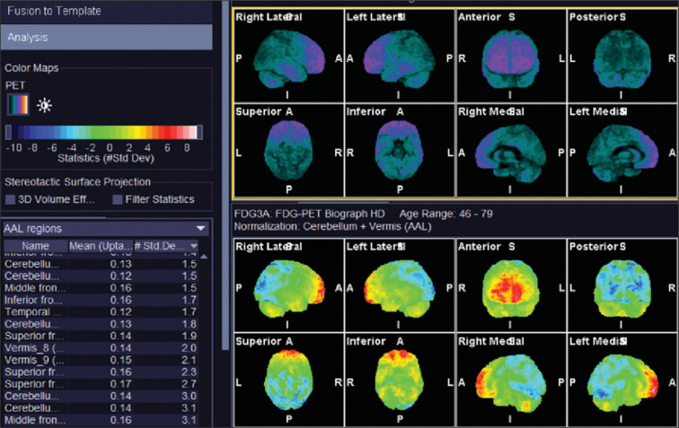 Autoimmune Encephalitis Pattern on PET-MRI in a Patient with Amyotrophic Lateral Sclerosis.