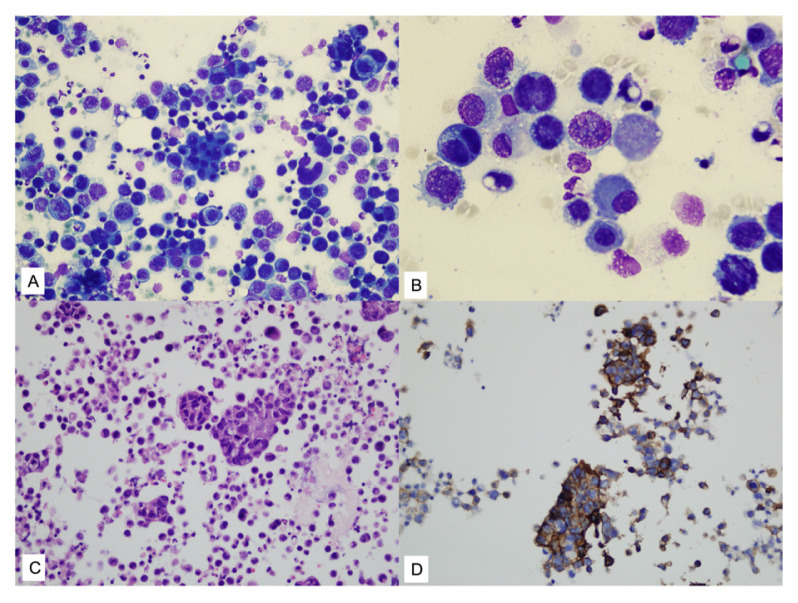 Cytopathological evaluation of pericardial effusions: 192 cases from a tertiary-level healthcare center.