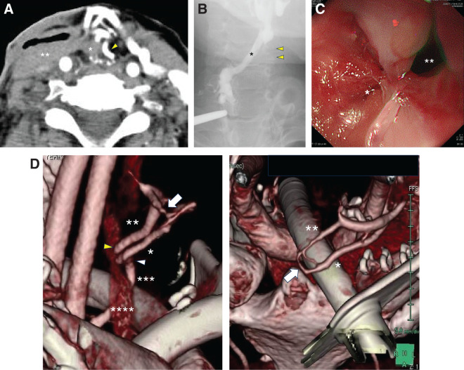 Late Graft Failure Due to Arterio-Venous Fistula in the Free Jejunal Graft Mesentery Following Total Pharyngo-Laryngo-Esophagectomy for Cervical Esophageal Cancer: A Case Report.