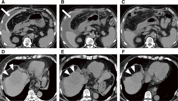 A Case of Unresectable Hepatocellular Carcinoma Treated with Spacer Placement Surgery with Bioabsorbable Spacer and Subsequent Proton Beam Therapy.