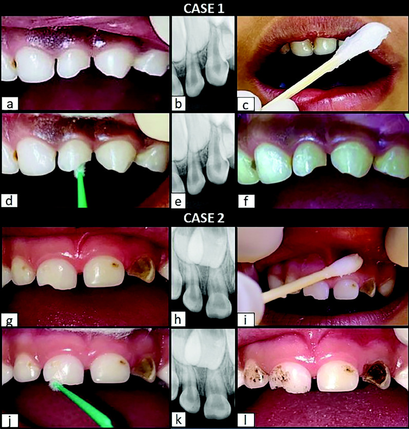 Application of Silver Diamine Fluoride in Dental Trauma: A Case Series Study.