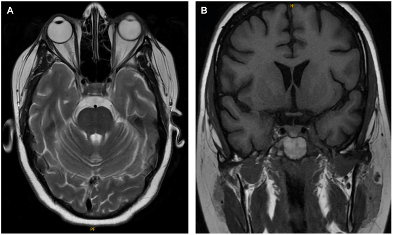 Finding the Culprit: Cushing Syndrome Secondary to Lung Carcinoid Tumor