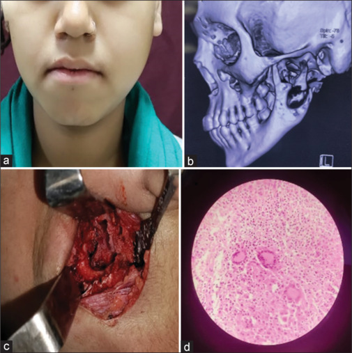 Tubercular osteomyelitis of mandible: Defining diagnostic criteria.