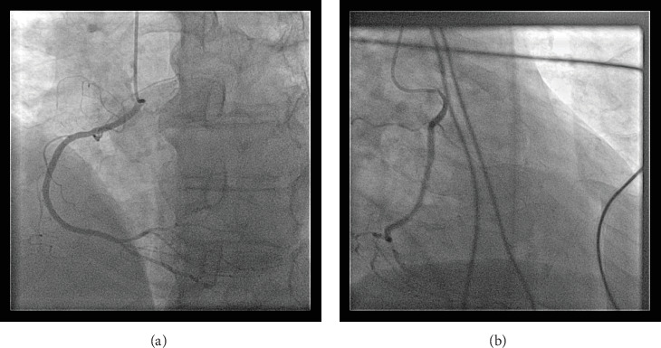 Anomalous Right Coronary Artery: Culprit or Innocent Bystander?