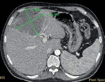 Primary squamous cell carcinoma of the liver.