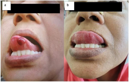 Epidemiology of Angina Bullosa Hemorrhagica: A Retrospective study.