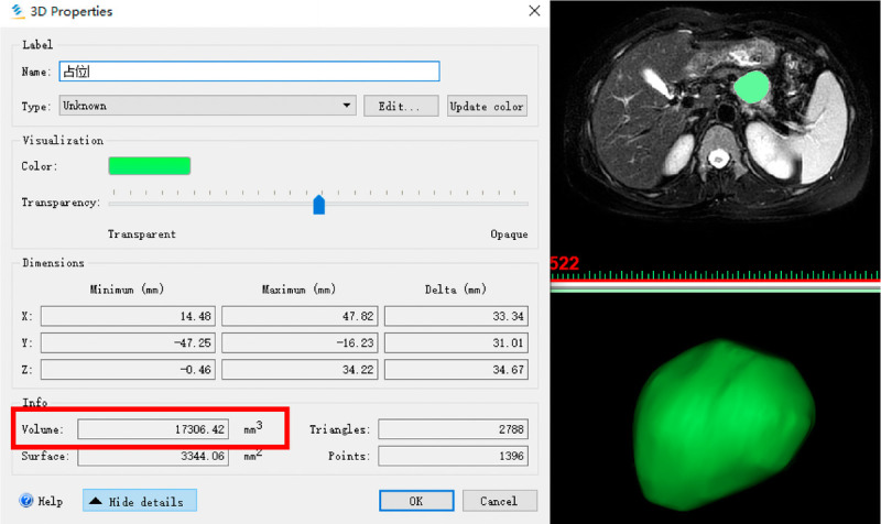 EUS-guided lauromacrogol ablation with different concentrations of lauromacrogol for the treatment of pancreatic cystic neoplasm: A randomized controlled study.