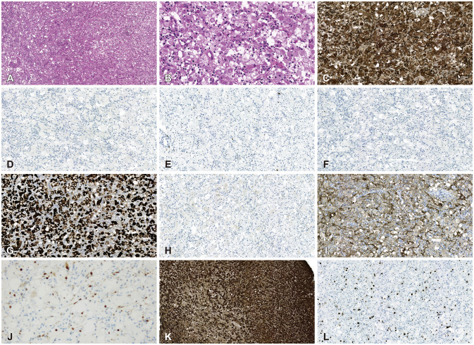 A Rare Case of Isolated Central Nervous System Neoplasm With Histiocytic Features.