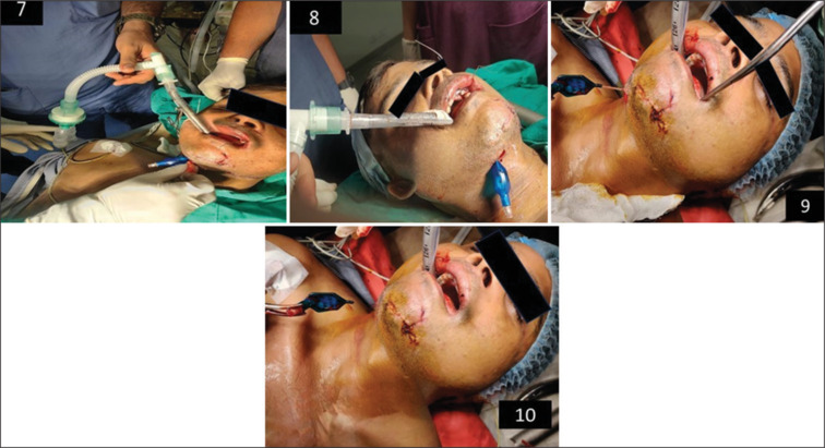 A new safer method for extubating patients of submental intubation - A case report.