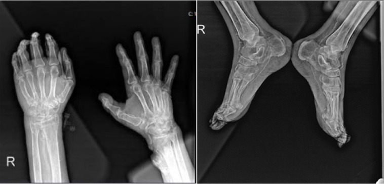 Calciphylaxis: A Mimic of Vasculitis.