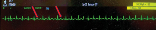 Decoding the Rhythm: The Additive Value of Left Atrial Appendage Flow in the Diagnosis of Atrial Tachyarrhythmias.