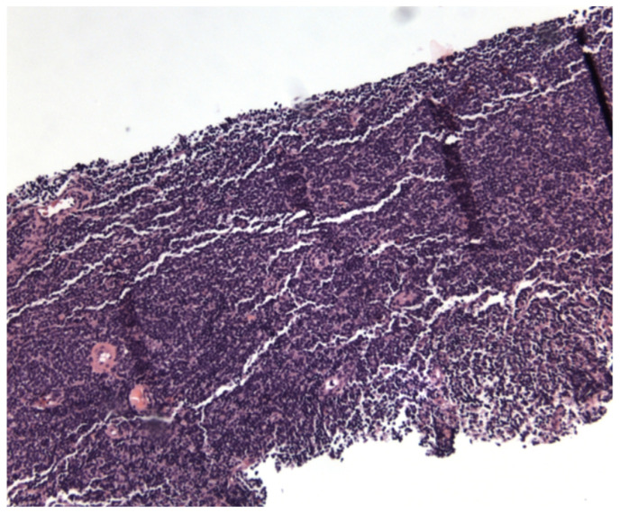 Marginal Zone Lymphoma in a Case of Hidradenitis Suppurativa Treated With Adalimumab Therapy.