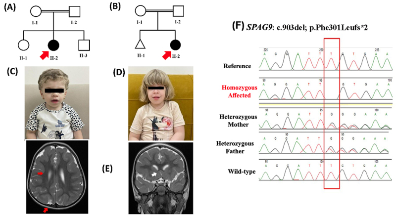 Truncated SPAG9 as a novel candidate gene for a new syndrome: Coarse facial features, albinism, cataract and developmental delay (CACD syndrome).