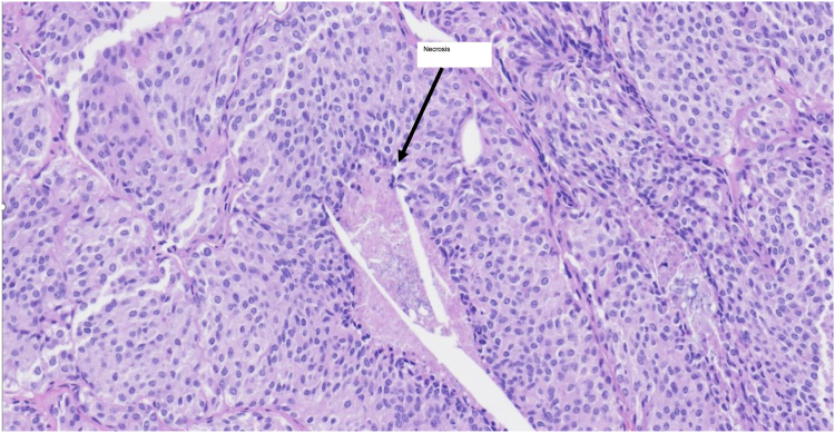 Finding the Culprit: Cushing Syndrome Secondary to Lung Carcinoid Tumor