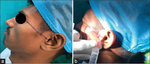 Evaluation of injectable platelet-rich fibrin (I-PRF) as a treatment in internal derangement of temporomandibular joint.