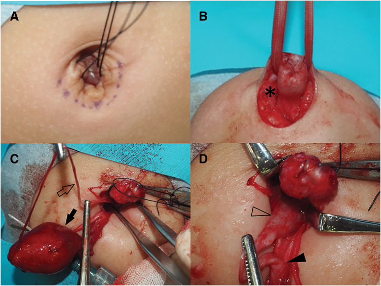 Coexisting Remnants of the Omphalomesenteric Duct and Urachus in an Infant.