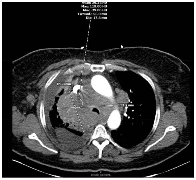 Marginal Zone Lymphoma in a Case of Hidradenitis Suppurativa Treated With Adalimumab Therapy.