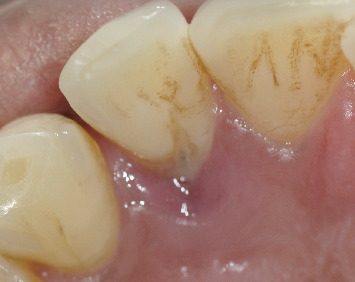 Successful Management of Palatal Developmental Groove-Associated Periodontal Defect Using Palatal Access Flap and Odontoradiculoplasty: A Case Report.