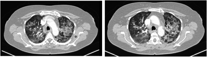 Safety of brigatinib following alectinib-induced-pneumonitis: Case report
