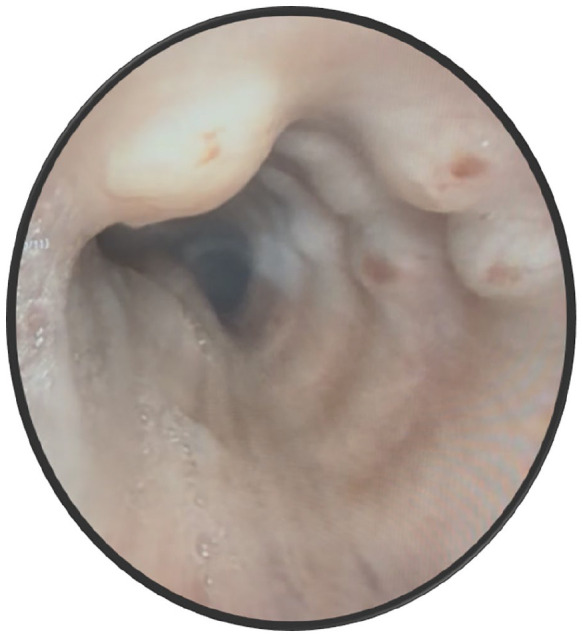 A Bumpy Ride Through a Turbulent Airway: But Not Always-A Case Report of Tracheobronchopathia Osteochondroplastica.