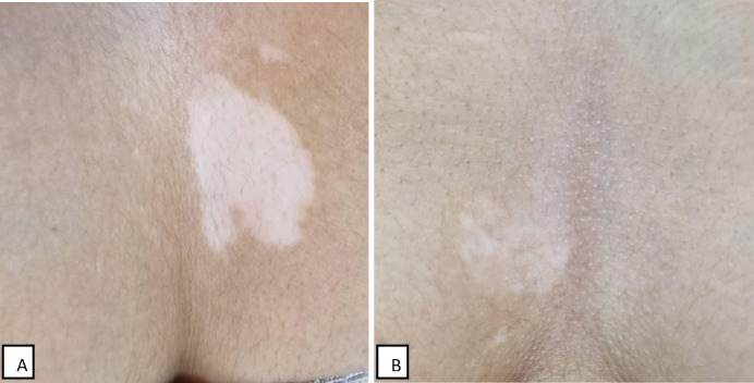 Enhancing Repigmentation in Vitiligo: A Comparative Clinical Trial of Microneedling with Topical 5-Fluorouracil, Fluocinolone, and Microneedling Alone.
