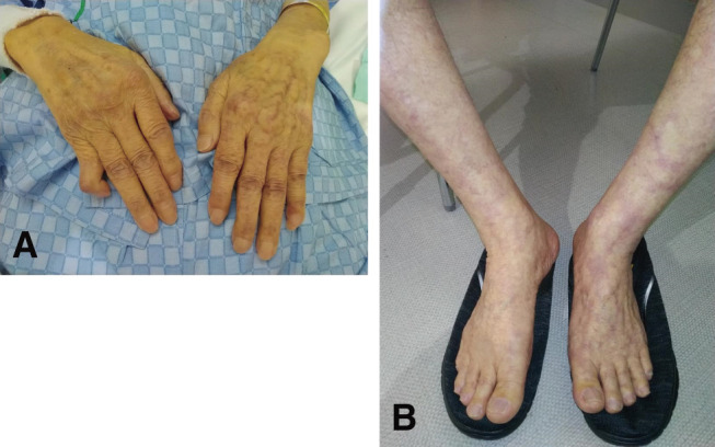 Abdominal Aortic Aneurysm with Primary Cold Agglutinin Disease Treated with Endovascular Aortic Repair.