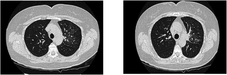 Safety of brigatinib following alectinib-induced-pneumonitis: Case report
