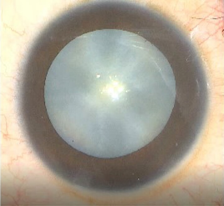 New-onset Type 1 Diabetes Mellitus Presenting as Bilateral Cataracts in a 15-year-old Girl.
