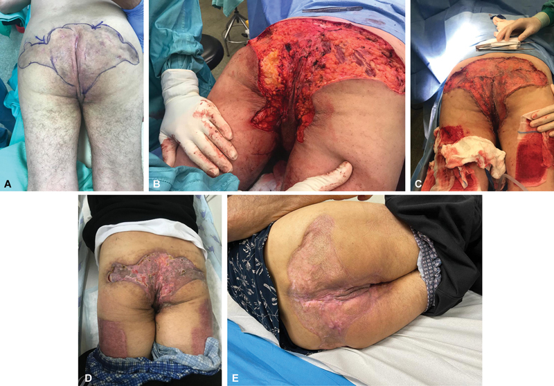 Immediate versus Delayed Wound Closure in Hidradenitis Suppurativa Surgery: A Comparative Outcomes Study.