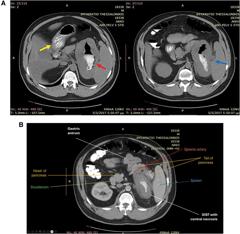 A Large Gastrointestinal Stromal Tumor under the Disguise of a Gastric Diverticulum: Report of a Case and Review of the Literature.