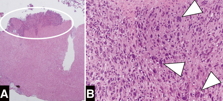 Rupture of the Abdominal Aorta without Aneurysm Associated with Giant Cell Arteritis: A Case Report.