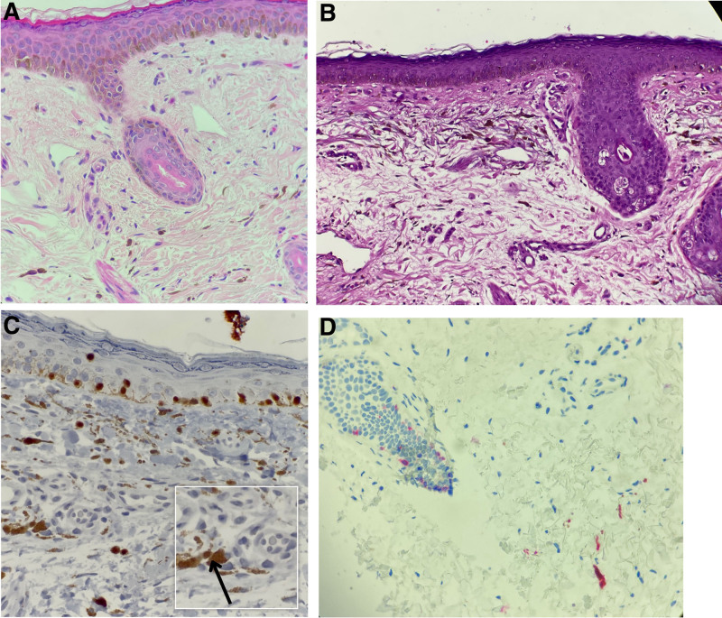 Nevus of Hori in African patients: an entity that is most likely underdiagnosed in clinical practice.