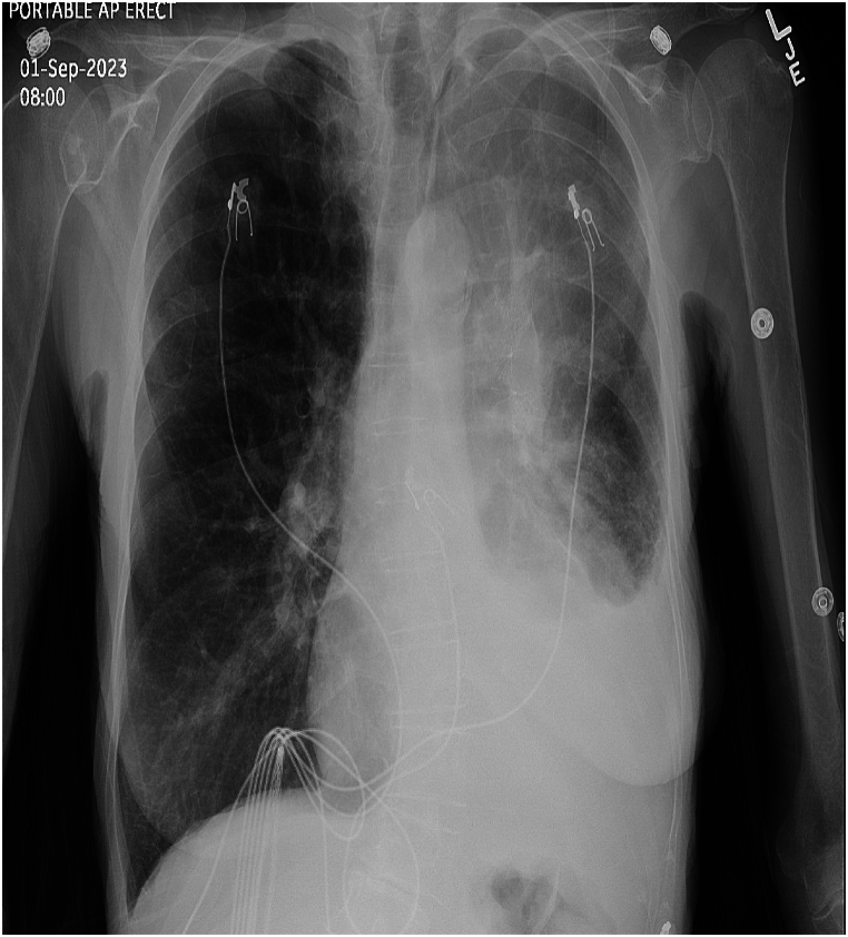 Bronchoscopic lung volume reduction complicated by ipsilateral pleural effusion