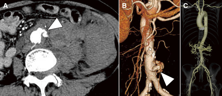 Rupture of the Abdominal Aorta without Aneurysm Associated with Giant Cell Arteritis: A Case Report.