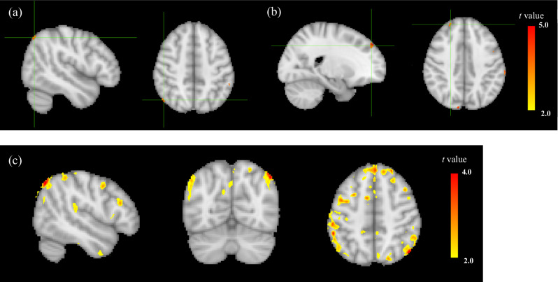 Impaired insight in schizophrenia is associated with higher frontoparietal cerebral blood flow: an arterial spin labeling study.