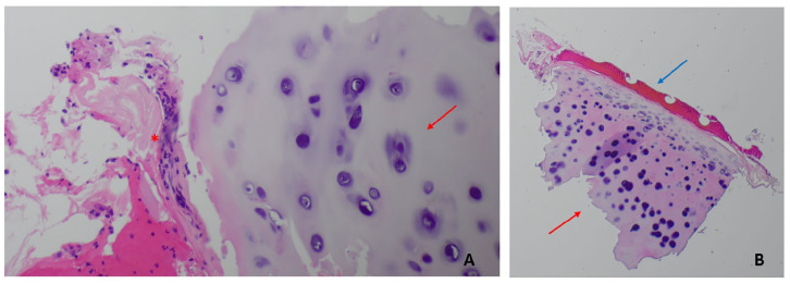 A Bumpy Ride Through a Turbulent Airway: But Not Always-A Case Report of Tracheobronchopathia Osteochondroplastica.
