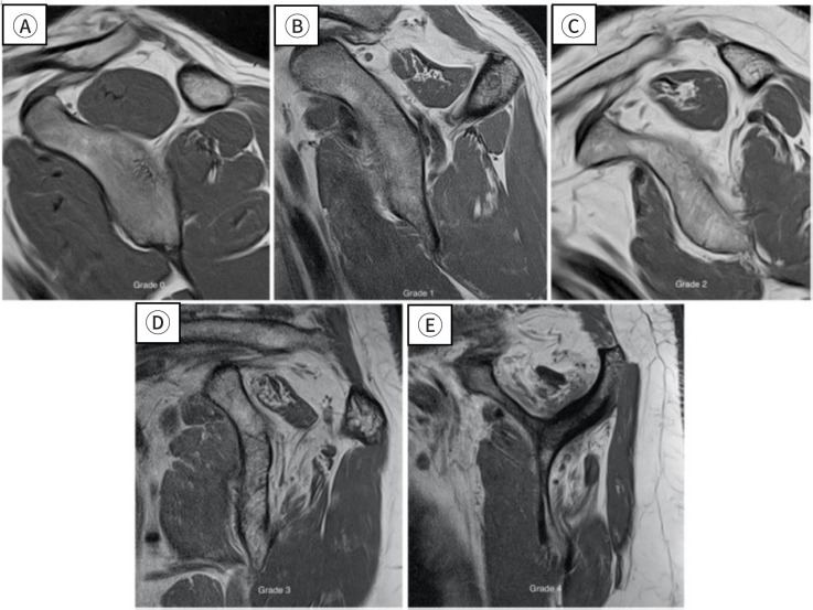 Radiological characteristics of shoulder diseases in older adults, including adhesive capsulitis, rotator cuff tear, and osteoarthritis of the glenohumeral joint: a narrative review.
