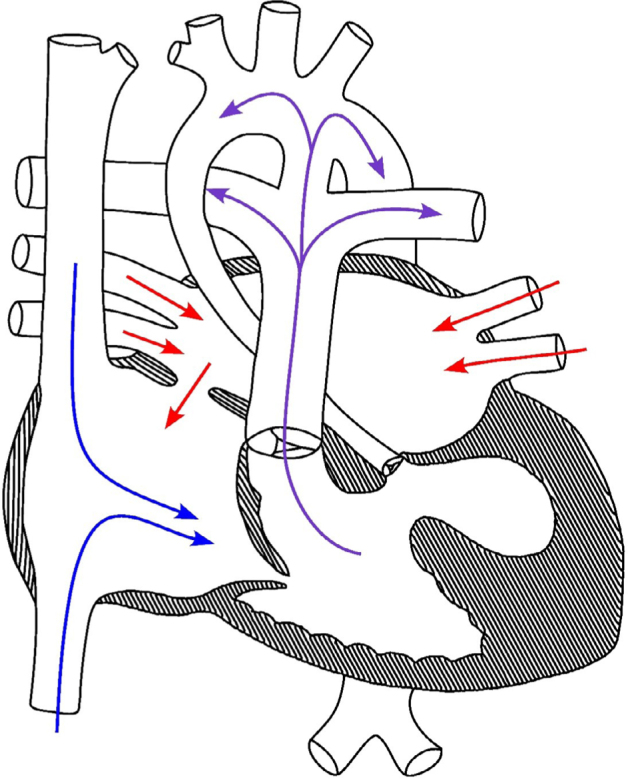 First report of hypoplastic left heart syndrome in 3p- syndrome and review of candidate genes.