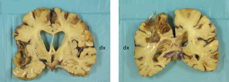 A de novo, mosaic and complex chromosome 21 rearrangement causes APP triplication and familial autosomal dominant early onset Alzheimer disease.