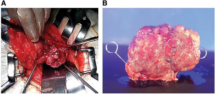 Gastroduodenal Intussusception with Gastric Adenocarcinoma: A Case Report and Review of the Literature.