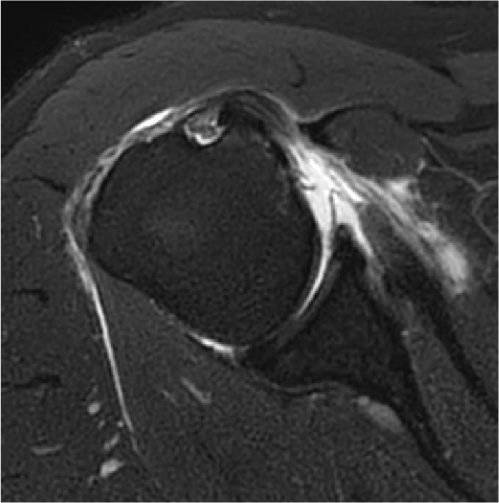 Radiological characteristics of shoulder diseases in older adults, including adhesive capsulitis, rotator cuff tear, and osteoarthritis of the glenohumeral joint: a narrative review.