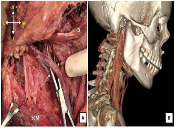Fenestration and Bifurcation of the Internal Jugular Vein; Surprises During Head and Neck Surgery.