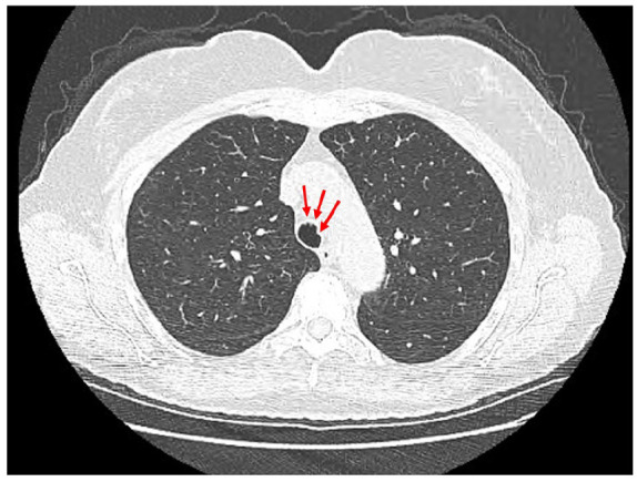 A Bumpy Ride Through a Turbulent Airway: But Not Always-A Case Report of Tracheobronchopathia Osteochondroplastica.